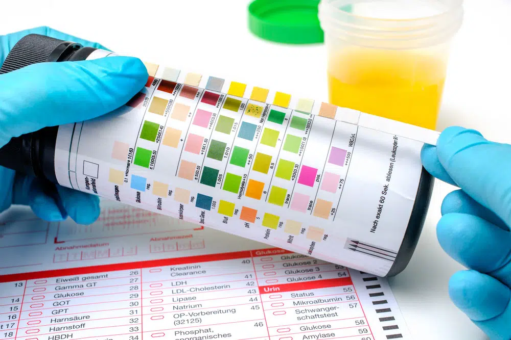 analyse bandelette test urinaire