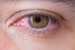 yeux rouges