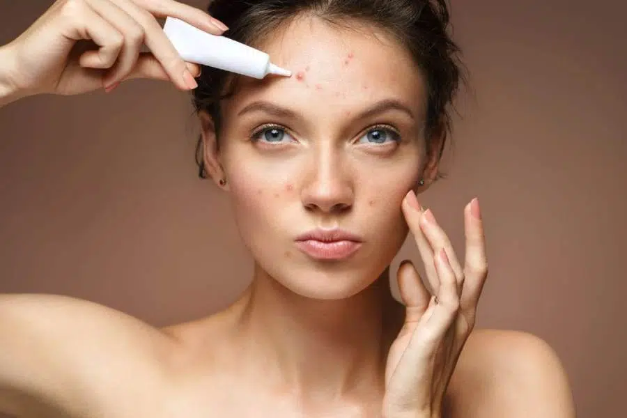 Une femme met de la crème sur ses boutons