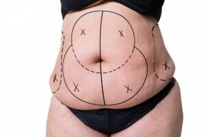 liposuccion savoir.jpg