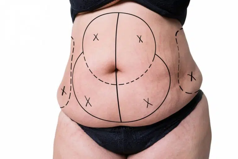 liposuccion savoir.jpg