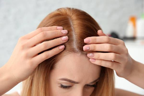 alopecie femme rousse