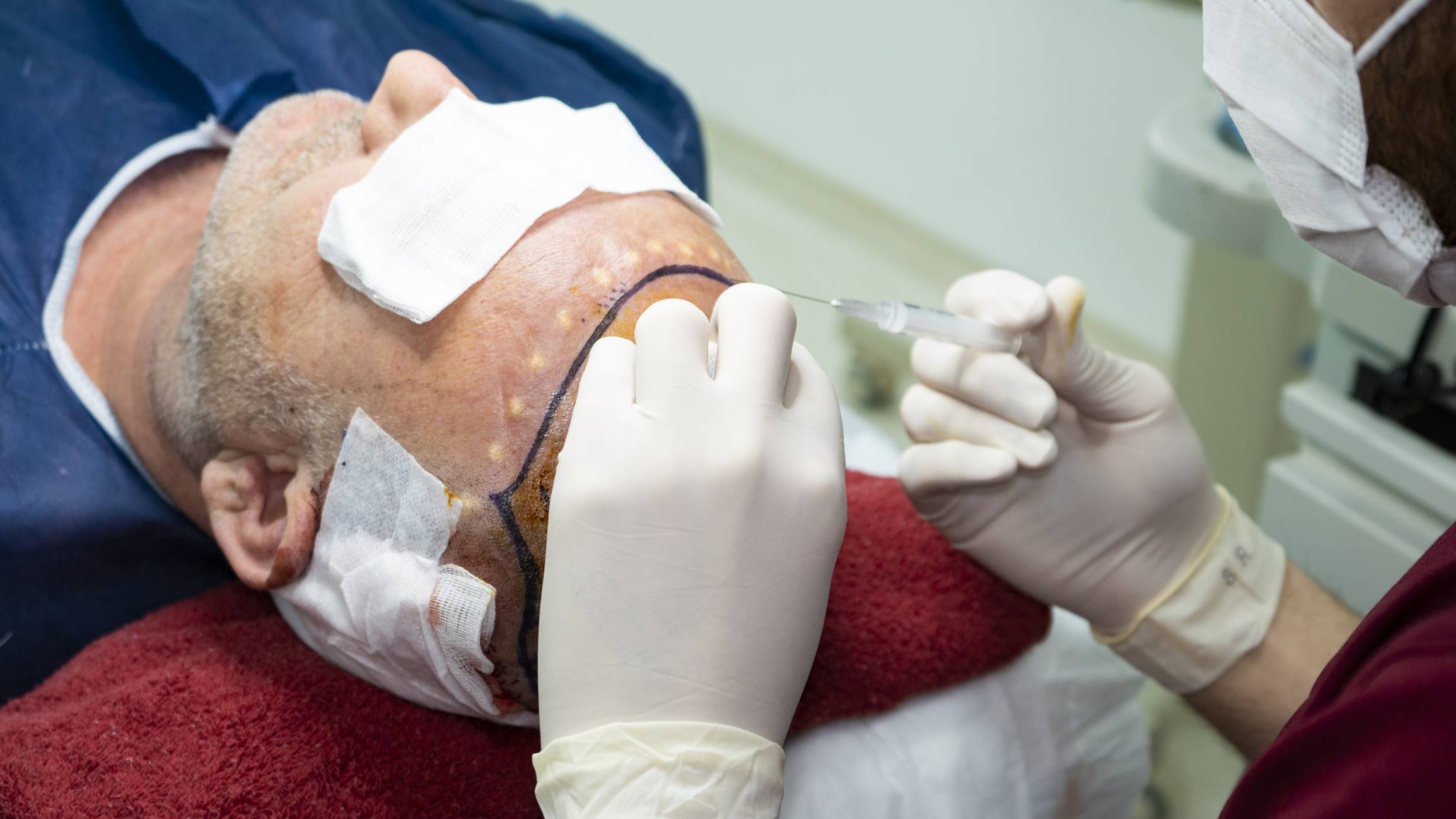 problèmes capillaires greffe de cheveux