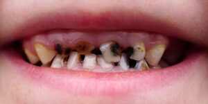 dents pourries