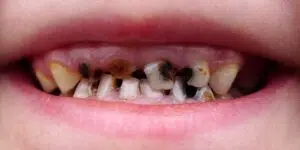 dents pourries