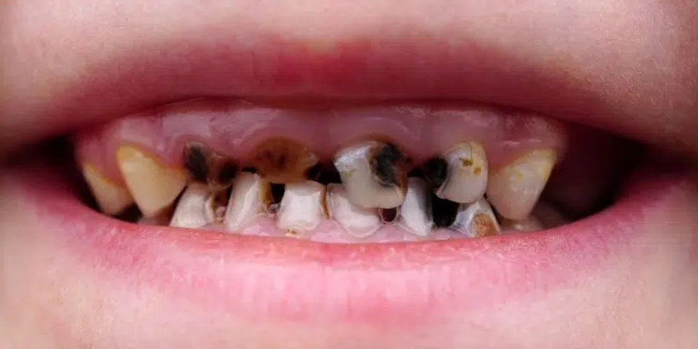 dents pourries