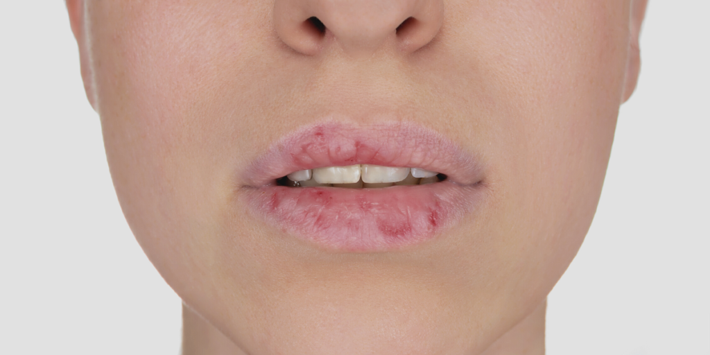 dermatillomanie