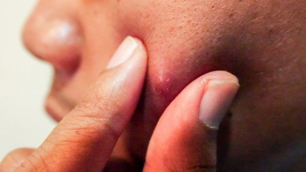 Keratoses-actiniques