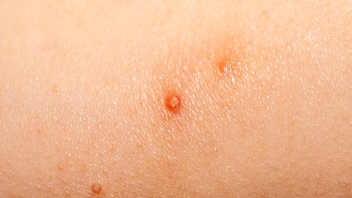 Keratoses-actiniques-cause