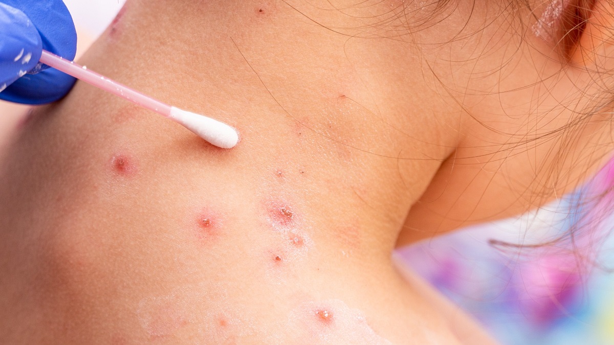 Keratoses-actiniques-complications