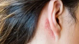 eczema-des-oreilles