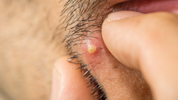 eczema-des-oreilles-traitement-symptome