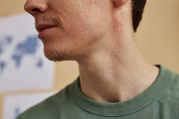 eruptions cutanees