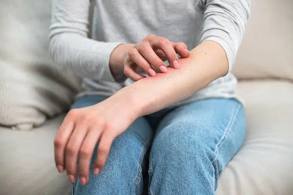 jeune femme qui se gratte le bras